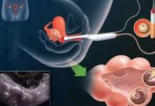 辛集市做试管婴儿怎么样？推荐这几家试管医院